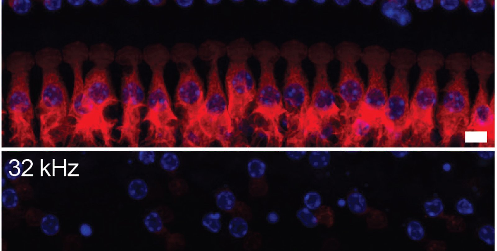 Two images representing inner ear health, one on top of the other. The top one shows more color (red and purple) indicating effectiveness of medication; the bottom one, also red and purple, shows hearing loss without medication.