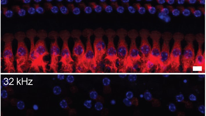 Two images representing inner ear health, one on top of the other. The top one shows more color (red and purple) indicating effectiveness of medication; the bottom one, also red and purple, shows hearing loss without medication.