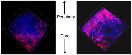 A tumor stained with pink biomarkers labeling gene regulation.