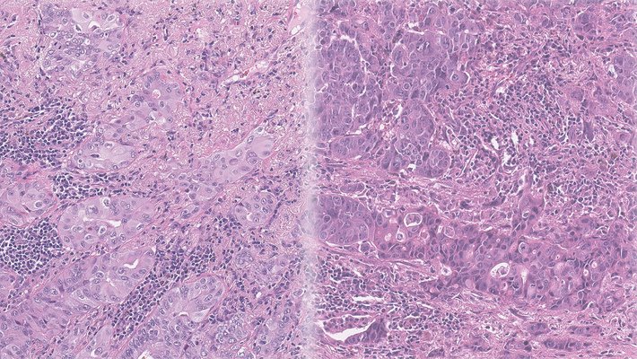 an image displaying purple-stained tissue samples from two different lung cancer patients
