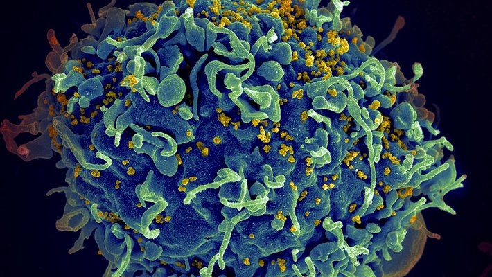 HIV (yellow) infecting a human cell