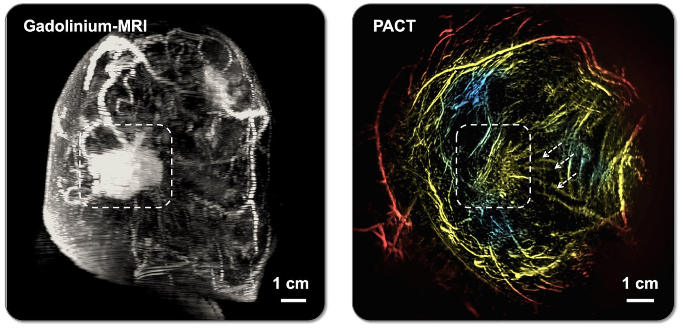 two breast lesion evaluation images. The one on the left is an MRI image, while the one on the right shows a PACT scan. The one on the right shows more vessels feeding a central carcinoma.