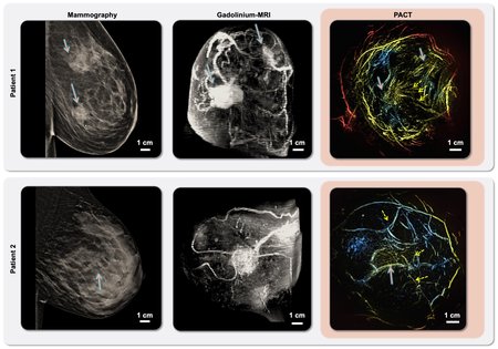 a side-by-side comparison of three different scans of a patient's breast with ductal carcinoma--mammography (left), MRI (center), and PACT (right).
