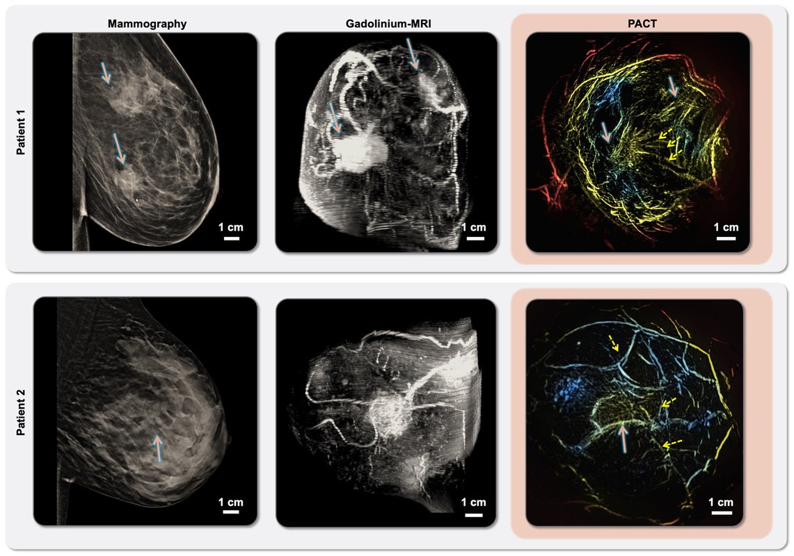 a side-by-side comparison of three different scans of a patient's breast with ductal carcinoma--mammography (left), MRI (center), and PACT (right).