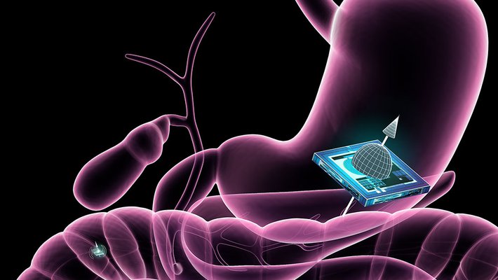 illustration of chip in gut