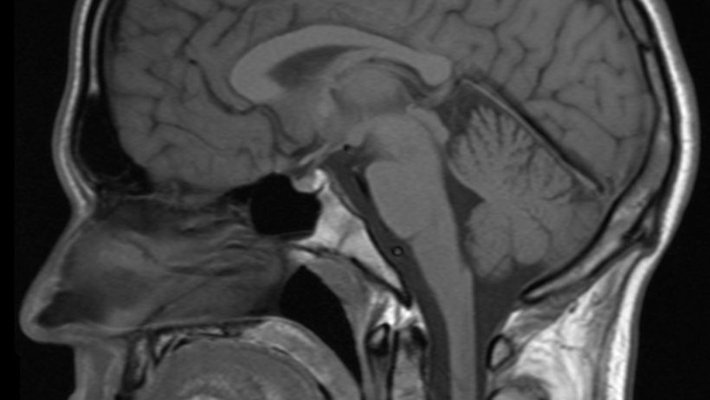 An MRI scan of the head. 