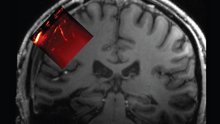 Drawing of human head from the back showing outline of skull, with a red rectangle on the left showing the area of the brain that can be imaged with ultrasound.