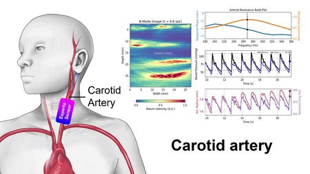 A graphic showing a purple box labeled "Esperto sensor" over the carotid artery. Ultrasound imaging shown along with measurements related to blood pressure in separate plots.